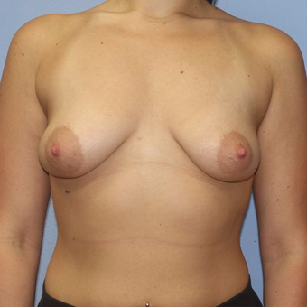 25-34 year old woman treated with Breast Augmentation before 3320639