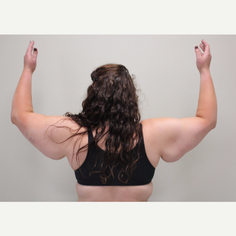 25-34 year old woman treated with Arm Lift before 3344032