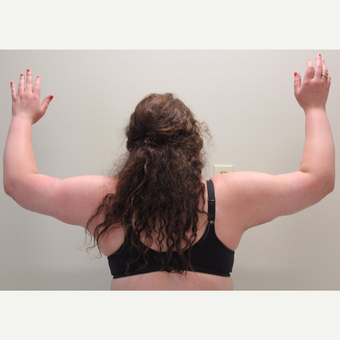 25-34 year old woman treated with Arm Lift after 3344032