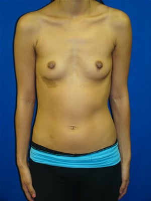 Breast Augmentation Surgery before 133276
