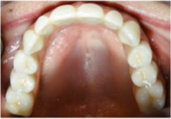 55-64 year old woman treated with Dental Implants after 2715305