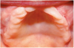 55-64 year old woman treated with Dental Implants before 2715305