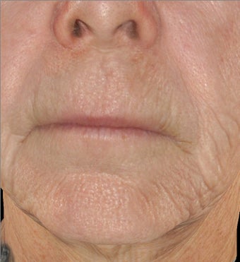 Infini - Microneedle Fractional Radiofrequency for Wrinkles 1275803