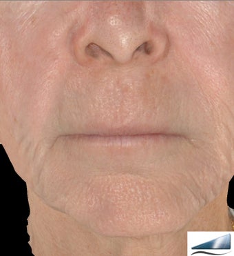 Infini - Microneedle Fractional Radiofrequency for Wrinkles 1275803