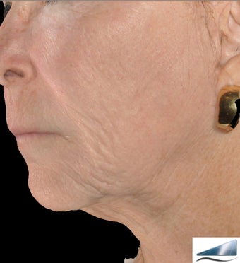 Infini - Microneedle Fractional Radiofrequency for Wrinkles after 1275803