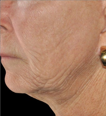 Infini - Microneedle Fractional Radiofrequency for Wrinkles before 1275803