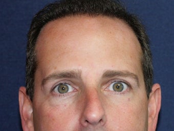 Before & After Male Botox Injections after 931515