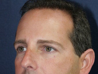 Before & After Male Botox Injections 931515