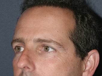 Before & After Male Botox Injections 931515