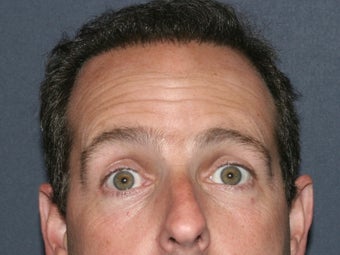 Before & After Male Botox Injections before 931515