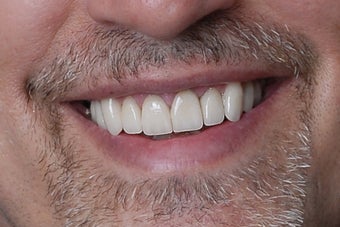 eMax Crowns and Veneers after 751637