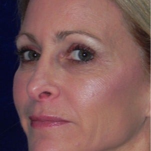 45-54 year old woman treated with Voluma after 2065318