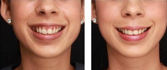 Gummy Smile Treated with Botox before 1083343