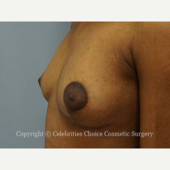 25-34 year old woman treated with Breast Reconstruction after 3768558