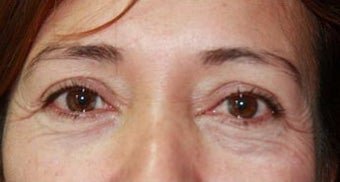 45-54 year old woman treated with Chemical Peel before 3417665