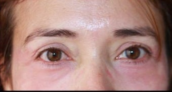 45-54 year old woman treated with Chemical Peel after 3417665