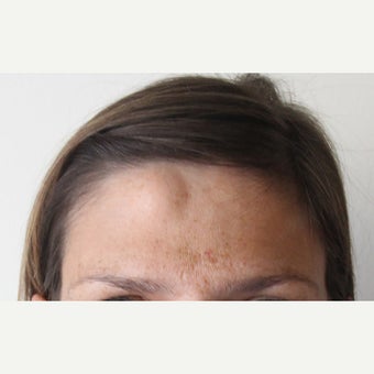 "Scarless" Forehead Mass Removal before 1712933