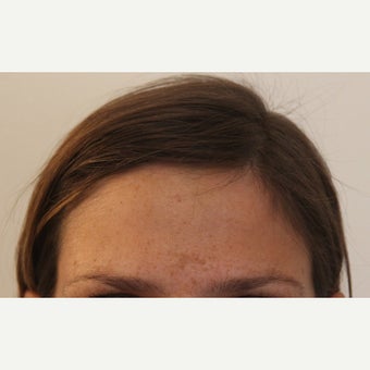"Scarless" Forehead Mass Removal after 1712933