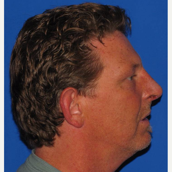 45-54 year old man treated with Rhinoplasty after 3618900