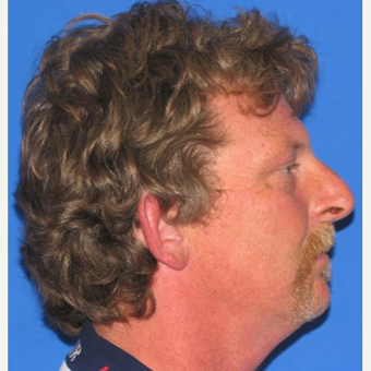 45-54 year old man treated with Rhinoplasty before 3618900