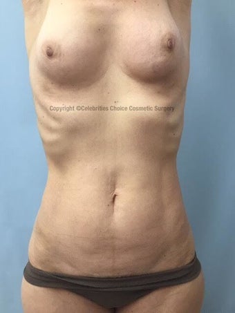 55-64 year old woman treated with Mommy Makeover before 3553989