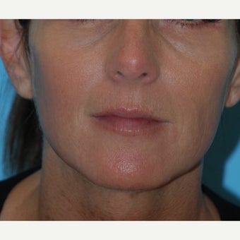 45-54 year old woman treated with Thermage, BBL and Juvederm to the lips and perioral region after 1726365