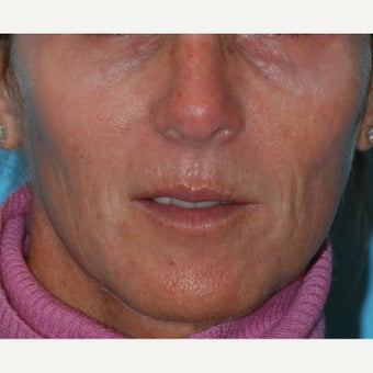 45-54 year old woman treated with Thermage, BBL and Juvederm to the lips and perioral region before 1726365