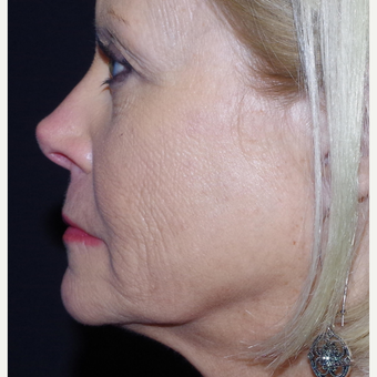 55-64 year old woman treated with ArteFill after 3645771