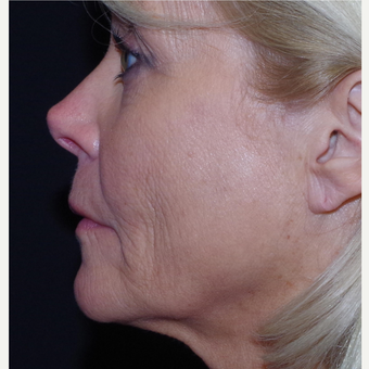 55-64 year old woman treated with ArteFill before 3645771