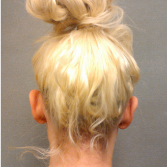 18-24 year old woman treated with Ear Surgery before 3650248