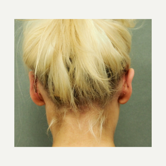 18-24 year old woman treated with Ear Surgery after 3650248