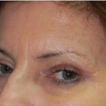59 year old woman treated with Fraxel Laser 1988615
