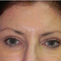 59 year old woman treated with Fraxel Laser after 1988615
