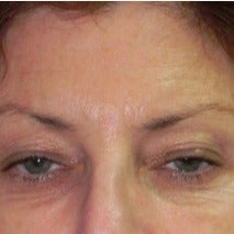 59 year old woman treated with Fraxel Laser before 1988615