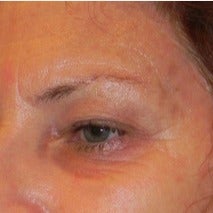 59 year old woman treated with Fraxel Laser 1988615