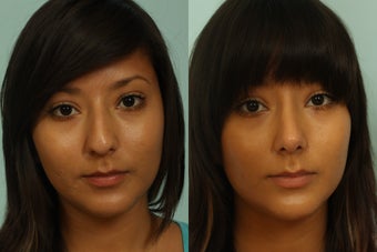 Female rhinoplasty 963026