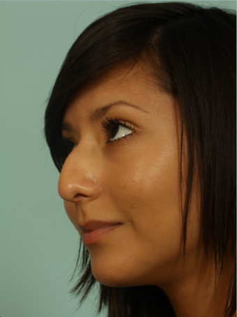Female rhinoplasty before 963026