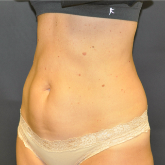 35-44 year old woman treated with SculpSure after 3623034