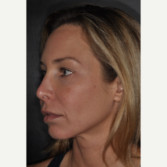 35-44 year old woman treated with Brow Lift 2 weeks post-op before 3452217