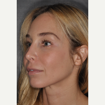 35-44 year old woman treated with Brow Lift 2 weeks post-op after 3452217