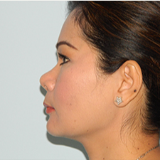 35-44 year old woman treated with Rhinoplasty before 3459159
