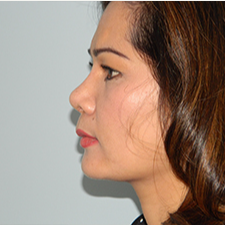 35-44 year old woman treated with Rhinoplasty after 3459159