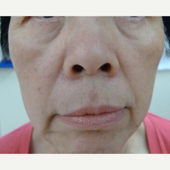 Asian skin treatments - age spots and dots, treatment with Erbium laser and Fractional laser after 1776372