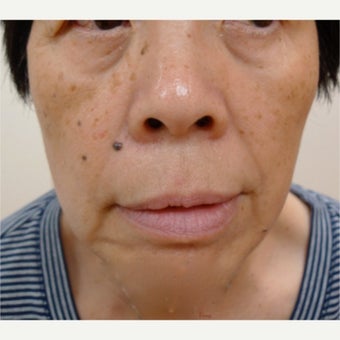 Asian skin treatments - age spots and dots, treatment with Erbium laser and Fractional laser before 1776372