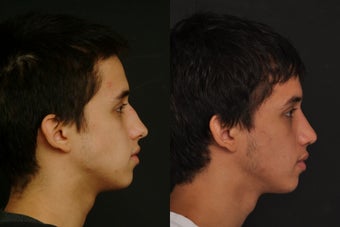 Septoplasty with nose reshaping after 1011468