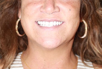 All-on-4 Dental Implants after 1138383