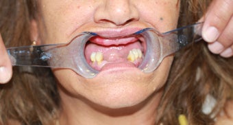 All-on-4 Dental Implants before 1138383