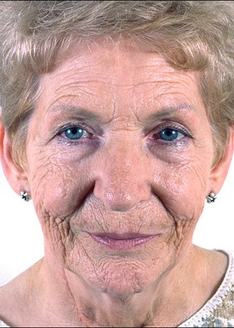Rhinoplasty and Chemical Peel before 1023244