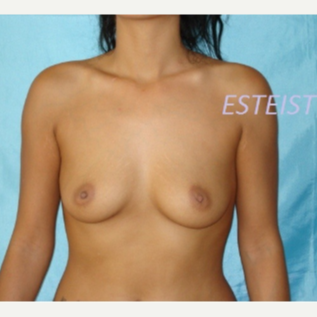25-34 year old woman treated with Breast Augmentation before 3841737