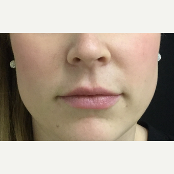 25-34 year old woman treated with Lip Augmentation after 3583520